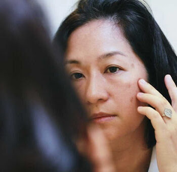 Da mặt khô sạm thường xuyên gặp ở phụ nữ tuổi trung niên