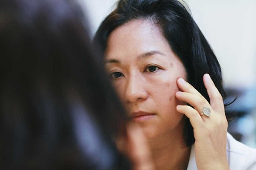 Da mặt khô sạm thường xuyên gặp ở phụ nữ tuổi trung niên