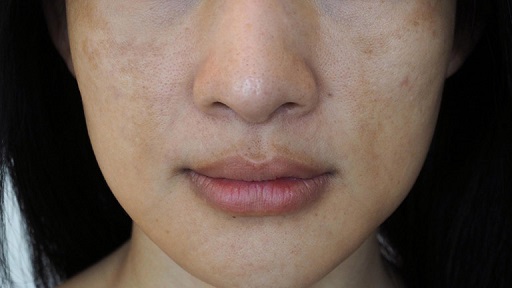 Top 5 cách khắc phục da không đều màu hiệu quả nhất, bạn đã thử chưa?